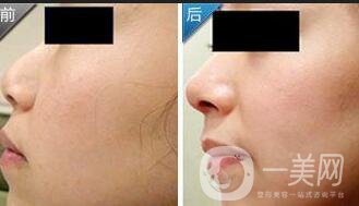 駝峰鼻矯正注意事項(xiàng)