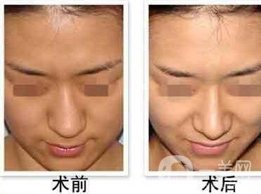 歪鼻矯正恢復(fù)時(shí)間