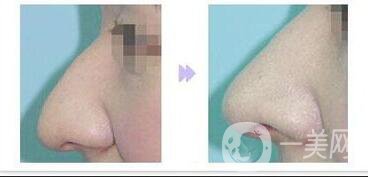 鷹鉤鼻矯正過程