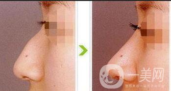 鷹鉤鼻矯正注意事項