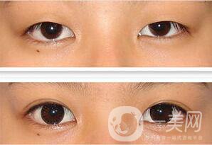 鄭州開(kāi)眼角*果