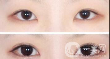 開(kāi)眼角醫(yī)院