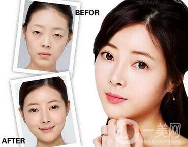 生物焊接雙眼皮價(jià)格是多少 貴不貴