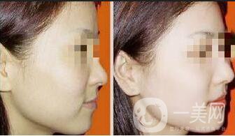 光子嫩膚,光子嫩膚調(diào)節(jié)黃褐斑,光子嫩膚調(diào)節(jié)黃褐斑優(yōu)缺點