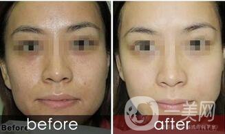 黑臉娃娃縮小毛孔多少錢(qián)