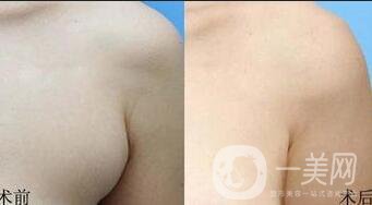 去副乳整形手術(shù)價格