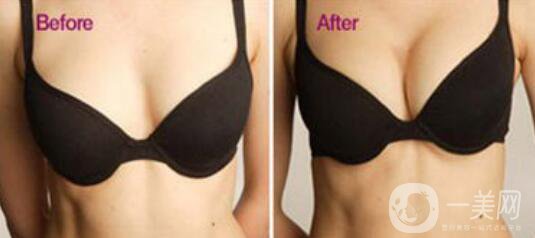 自體豐胸手術費用