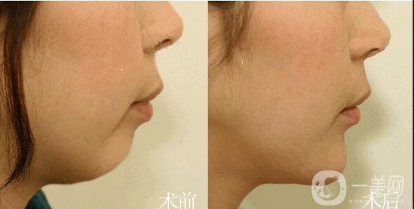 自體骨墊下巴報(bào)價(jià)