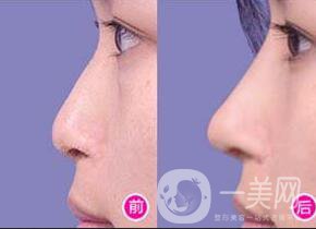 玻尿酸隆鼻價(jià)格,玻尿酸隆鼻價(jià)位