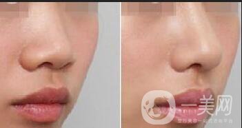 鼻翼縮小多少錢 