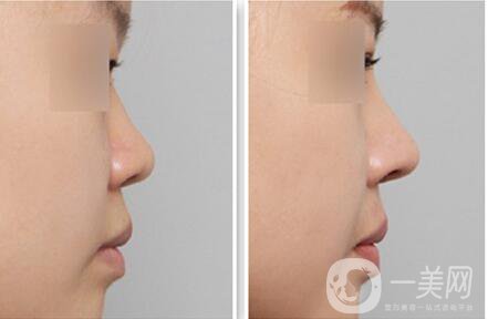 玻尿酸隆鼻價格