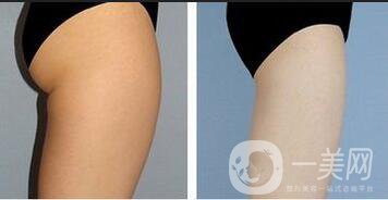 上海臀部抽脂價格