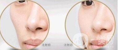 自體脂肪填充臉頰多少錢(qián)