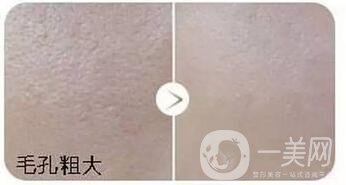 彩光嫩膚手術(shù)價格