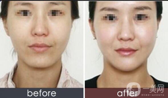 超聲法瘦臉,超聲法瘦臉價(jià)格