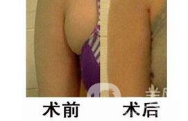 副乳切除多少錢