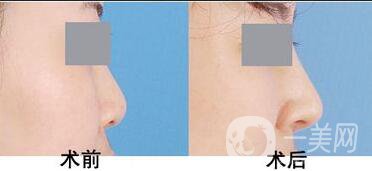 耳軟骨隆鼻手術多少錢