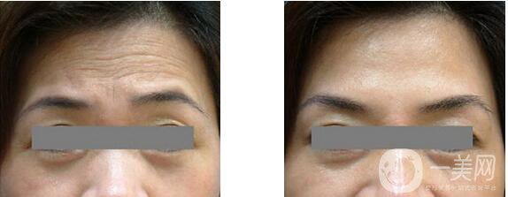 抬頭紋如何形成的 抬頭紋很深怎么辦？