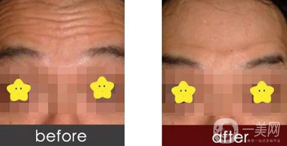 抬頭紋如何形成的 抬頭紋很深怎么辦？