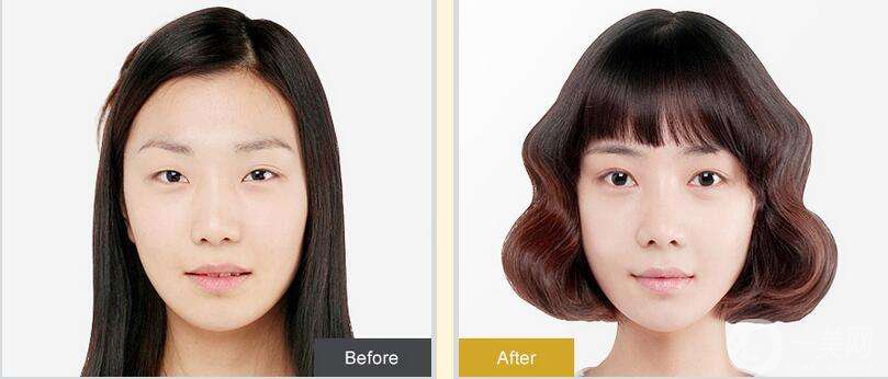 割雙眼皮三天能不腫嗎 多長時間能消腫