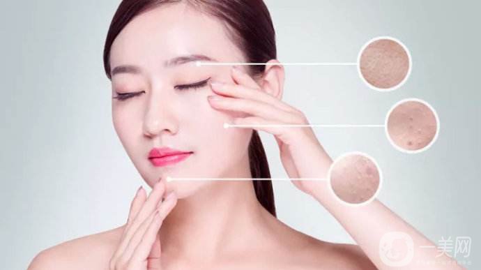 激光祛痘*果怎么樣 激光祛痘好不好