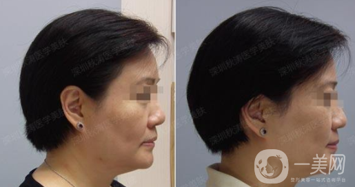 美容手術(shù)拉皮價格多少 美容拉皮好不好