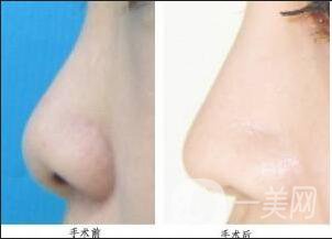 鼻翼縮小多少錢,注意事項