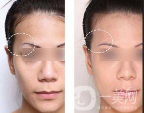 膨體豐太陽穴報價,膨體豐太陽穴注意事項(xiàng)