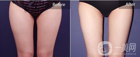 大腿光纖溶脂,大腿光纖溶脂*果