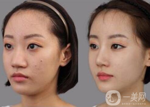 鼻頭縮小手術(shù)費用,鼻頭縮小術(shù)后注意事項