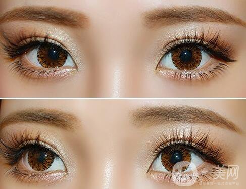 玻尿酸填充臥蠶價(jià)格,玻尿酸填充臥蠶風(fēng)險(xiǎn)