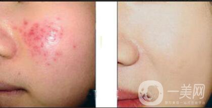 果酸換膚多少錢,果酸換膚注意事項(xiàng)