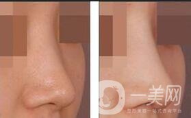 硅膠隆鼻,硅膠隆鼻*果