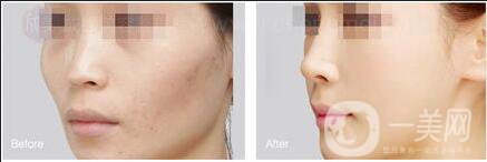 自體脂肪填充危害,自體脂肪填充注意事項(xiàng)