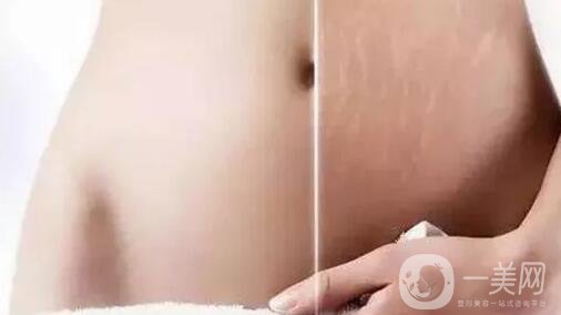 去妊娠紋價(jià)格是多少？