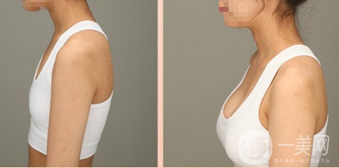 假體豐胸術后痛多久能恢復正常 怎么護理