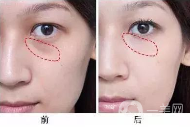 填充淚溝能維持多久 填充淚溝的方法