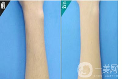 手臂激光脫毛價(jià)格 激光脫毛*果如何