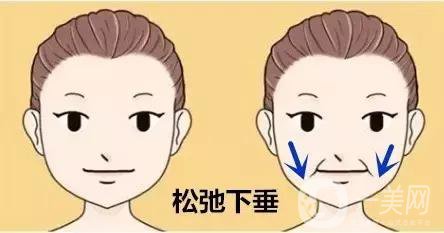 玻尿酸去法令紋的價(jià)格 去法令紋的方法