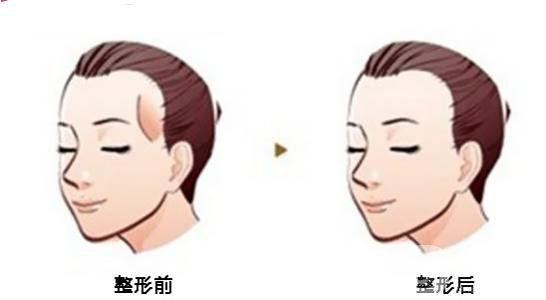 硅膠豐太陽穴貴嗎 硅膠豐太陽穴價格