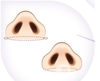 鼻翼縮小整形價格,鼻翼縮手術注意事項