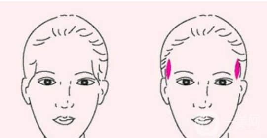 膨體豐太陽穴報價 膨體豐太陽穴的*果
