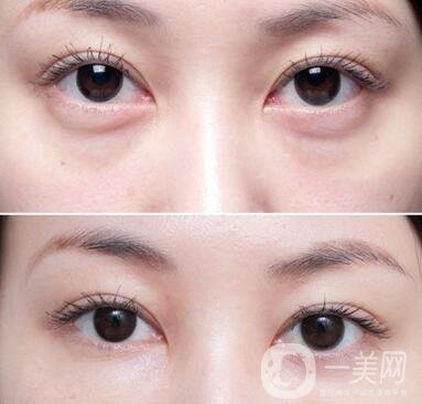 溶脂去眼袋價格