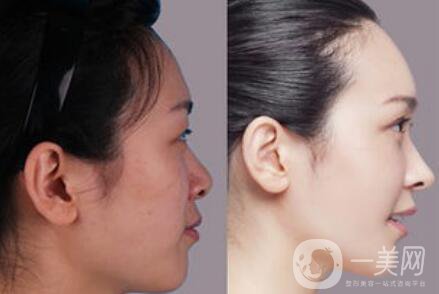 假體隆鼻價(jià)格