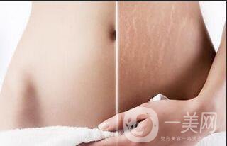 祛妊娠紋價(jià)位