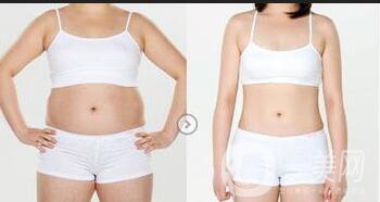 水動(dòng)力吸脂方法,水動(dòng)力吸脂*果