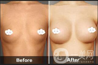 娜綺麗隆胸多少錢,隆胸注意事項(xiàng)