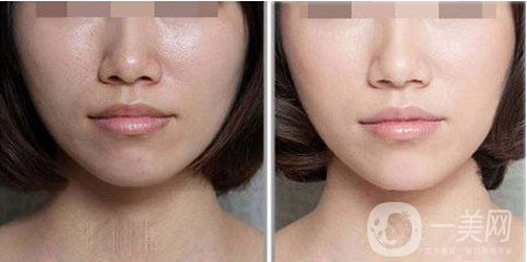 鐳射激光嫩膚是什么 主要有哪些作用？