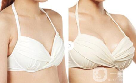 手術(shù)吸脂隆胸貴嗎 隆胸手術(shù)*果怎么樣