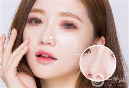 玻尿酸隆鼻手術需要多少錢 *果怎么樣？